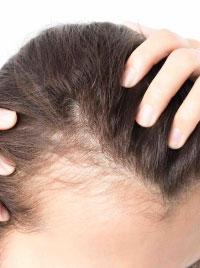 ANDROGENIC HAIR THINNING
